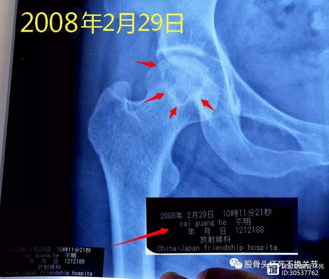 大连人工骨头医保报销多少(人工骨头医保报销多少比例)